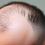 hair loss treatment for men, hair treatment for hair loss, hair regrowth for men